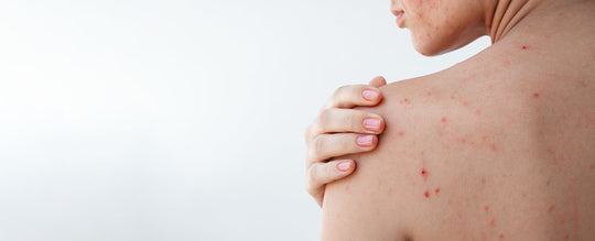 Acne dopo l’estate: cos’è l’effetto rebound e come prevenirlo