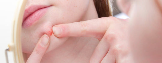 gestire l'acne in pre-adolescenza