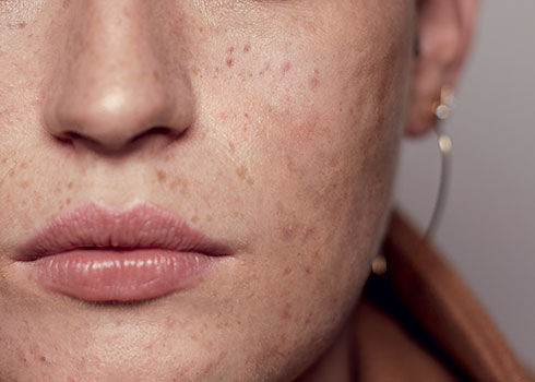 trattare la pelle acneica