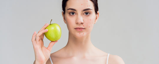 Acne e alimentazione: come il cibo può influire sulla tua pelle