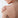 ACNE DOPO L'ESTATE: COME PREVENIRLA?